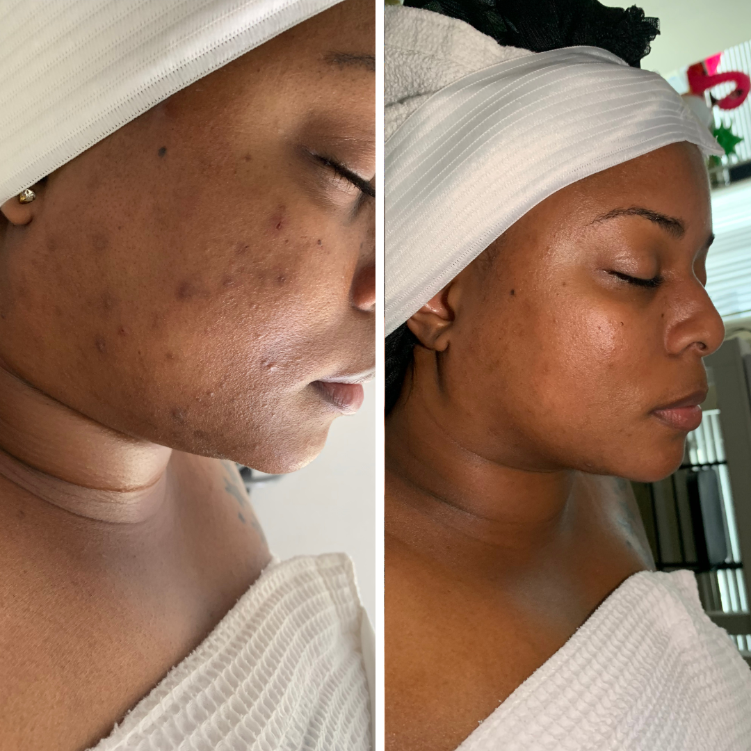 Acne Transformation Program