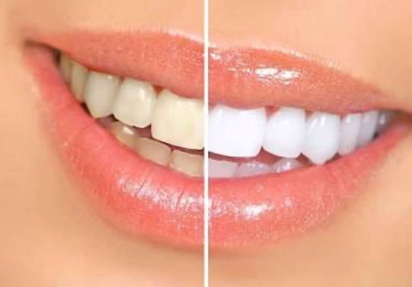 Teeth Whitening at Envy’s Krysta and Grace in Bay City, MI