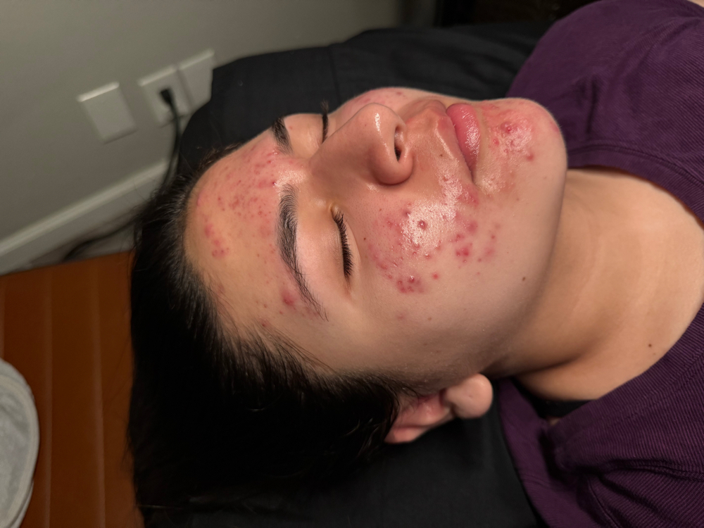Acne Facial