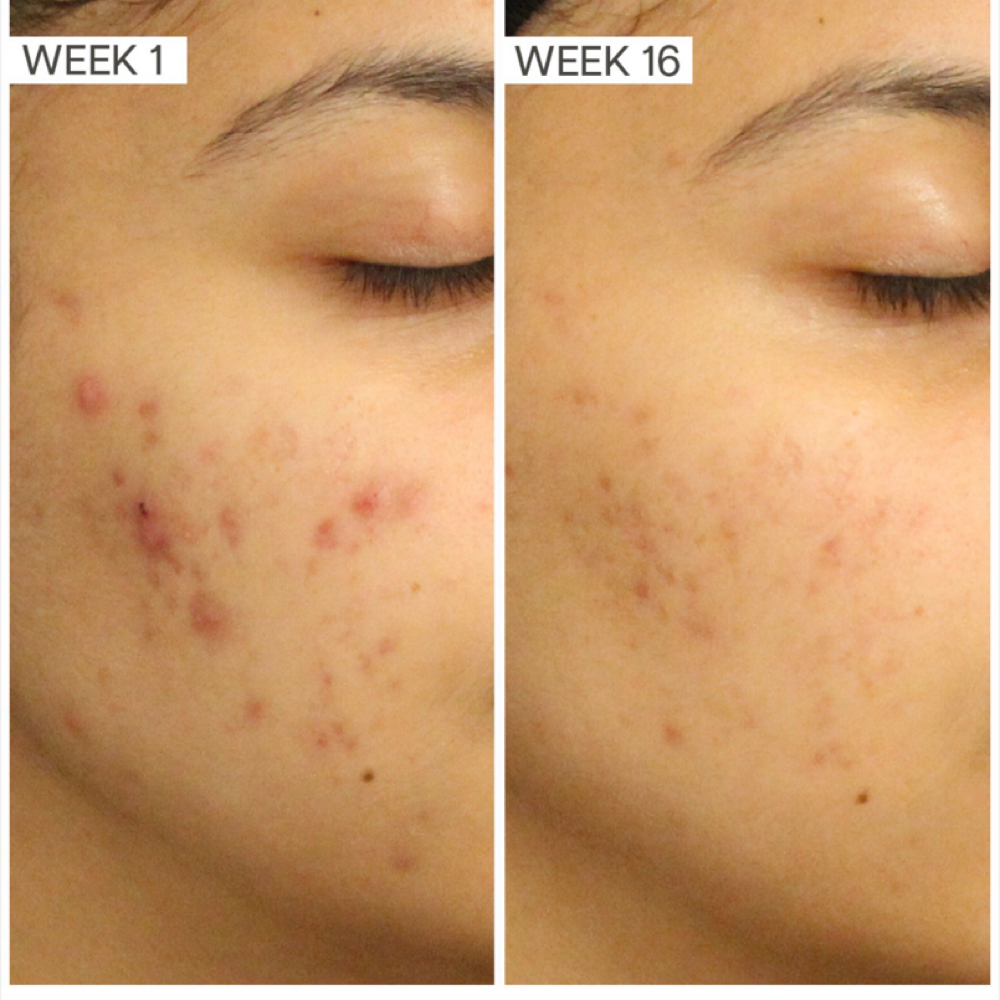 Acne BC Consultation+1st Treatment at Sun & Moon Aesthetics in Fort Walton Beach, FL