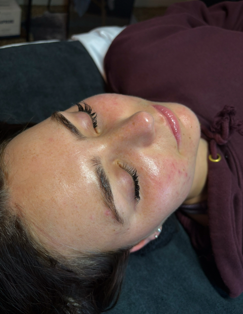 Acne Bootcamp Treatment
