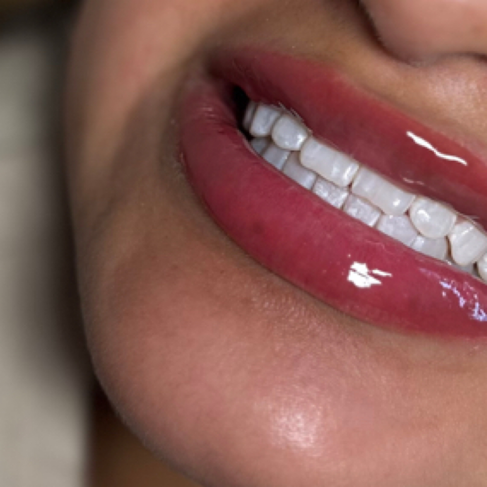 1 Hour Teeth Whitening at AIKO AESTHETICS in Melrose Park, IL