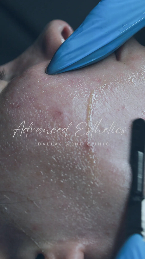 Hyperpigmentation Facial