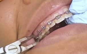 Braces Removal at BG Cosmetic in Inglewood, CA