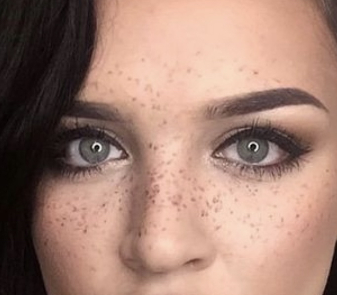 Freckles