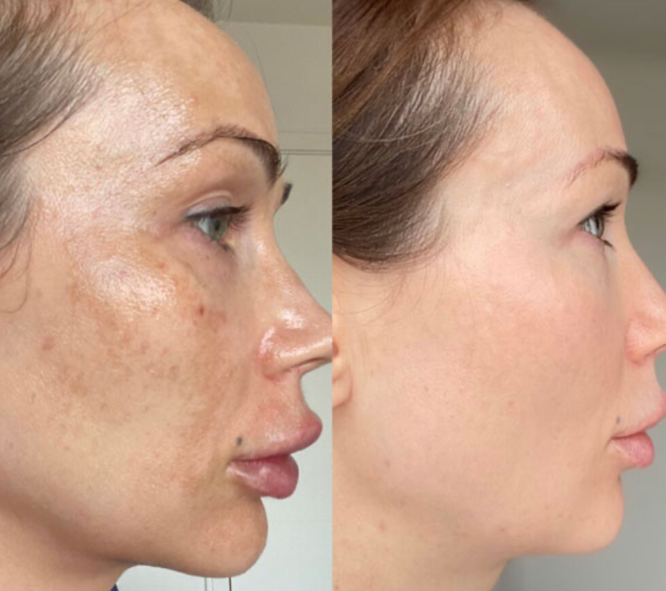 Cosmelan Peel