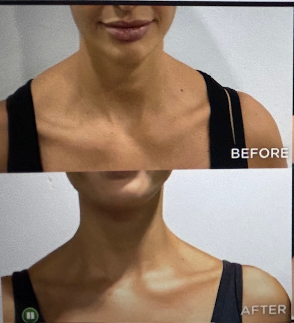 Barbie Tox (Trapezius Tox) at Enhanced Beauty by Irma in Houston, TX