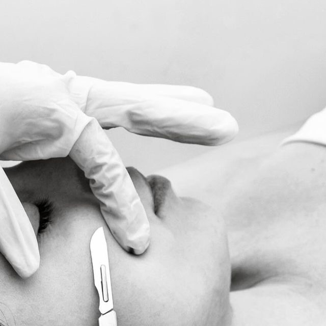 Dermaplaning