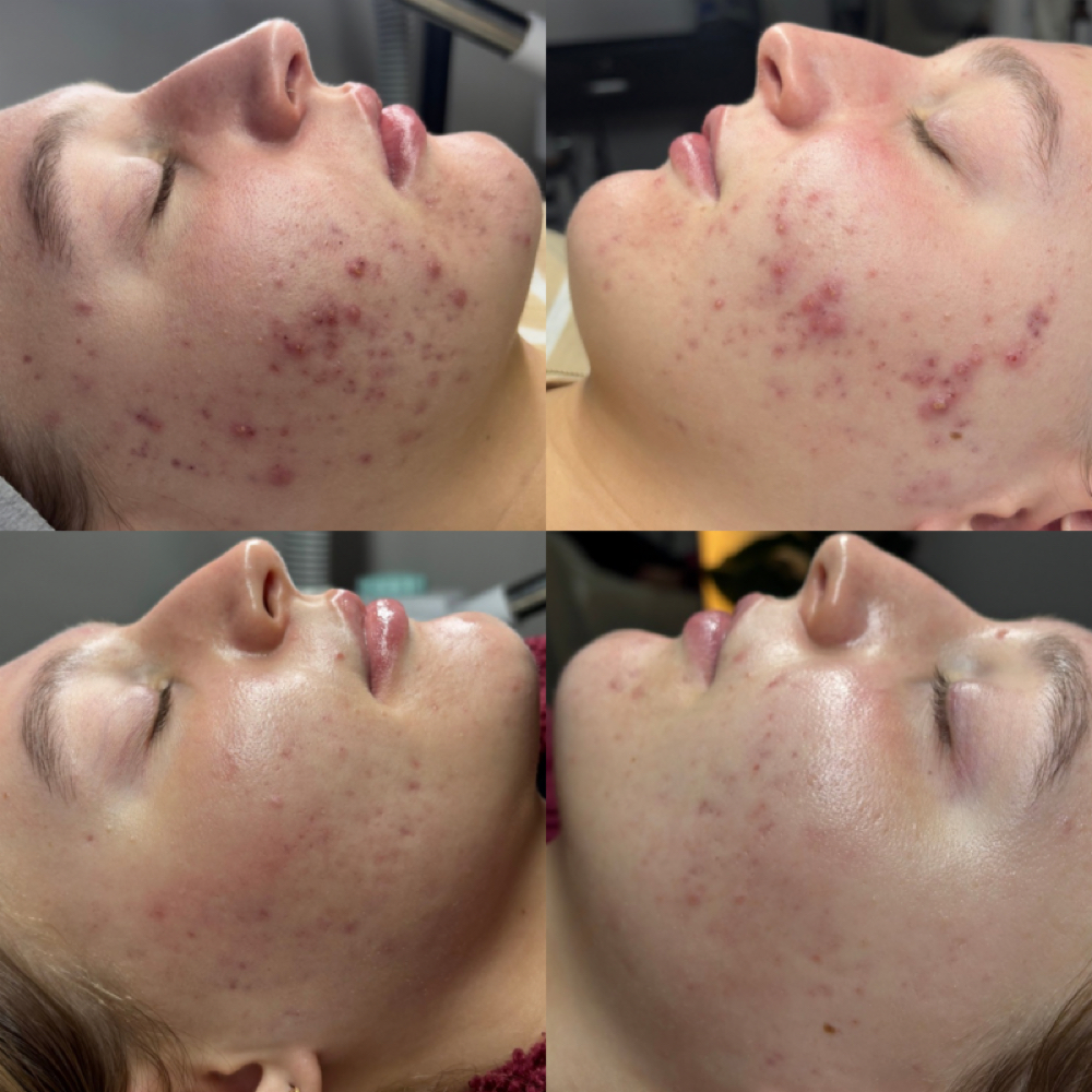 Acne Bootcamp Treatment at Salt + Mane Co. in Aurora, IN