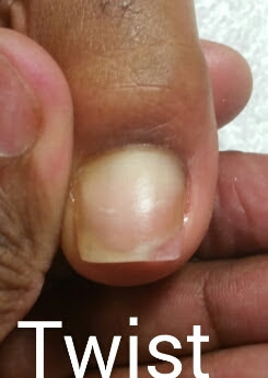 Toe repair/enhancement