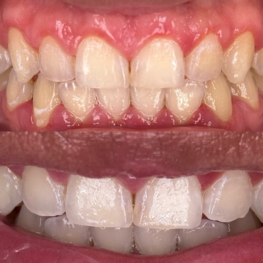 Teeth whitening at Gloo Beauty in Port Neches, TX