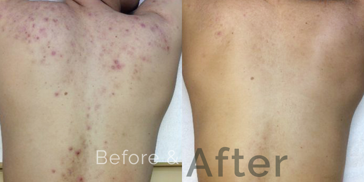 Acne-Refining Back Peel Treatment