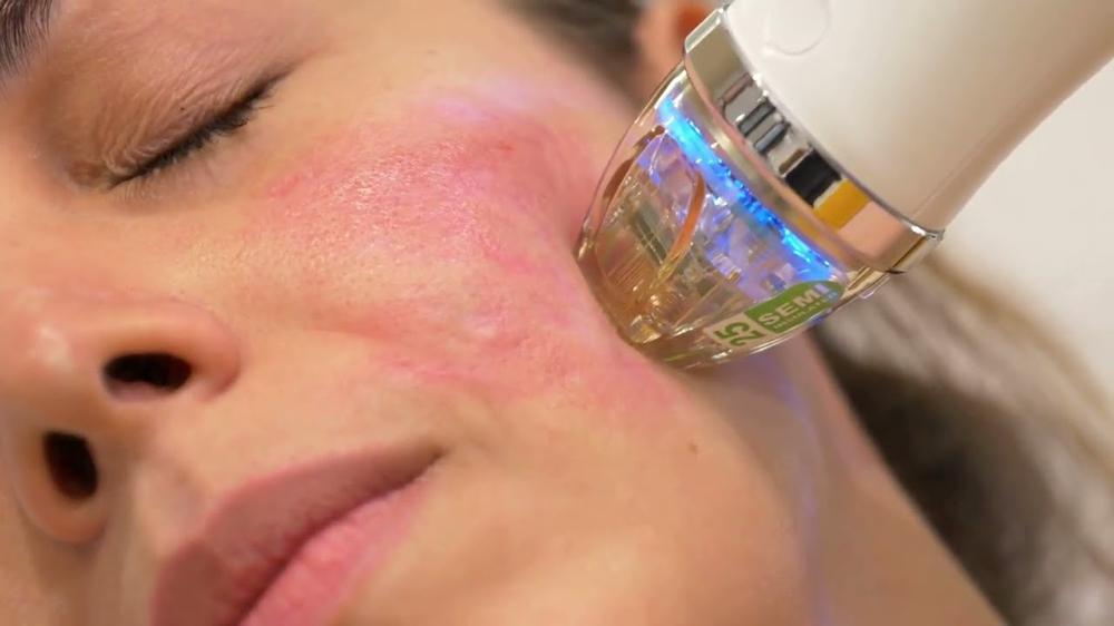 Radiofrecuencia Fraccionada at Ella’s Beauty Studio LLC in Denver, CO