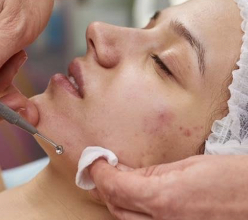 Acne Resurfacing FacialMedTreatment