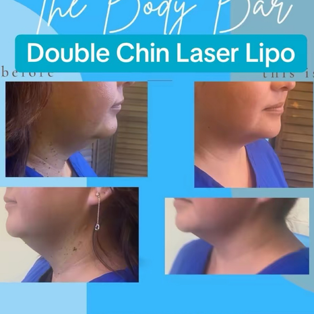 Double Chin Reduction(Non Invasive) at 210 The Body Bar | San Antonio Lux Spray Tans & Body Sculpting in San Antonio, TX
