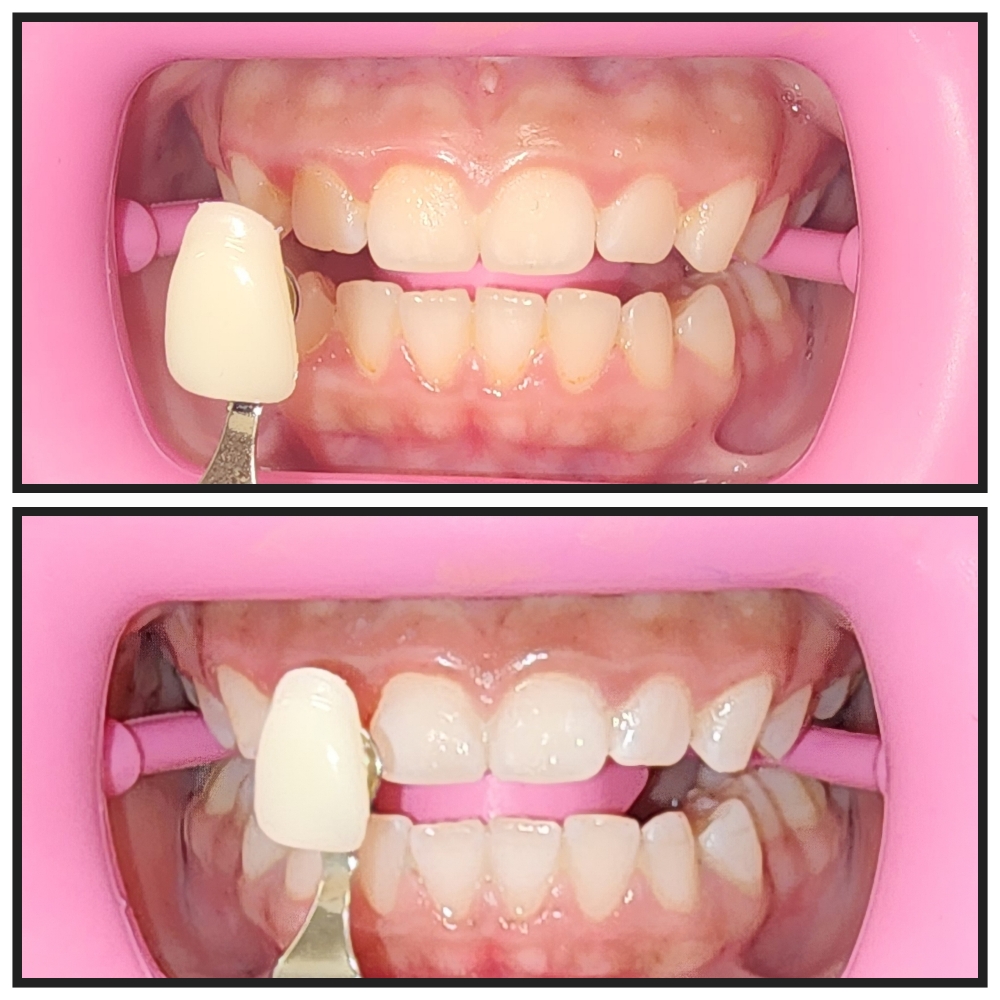 Teeth Whitening (40 Mins)