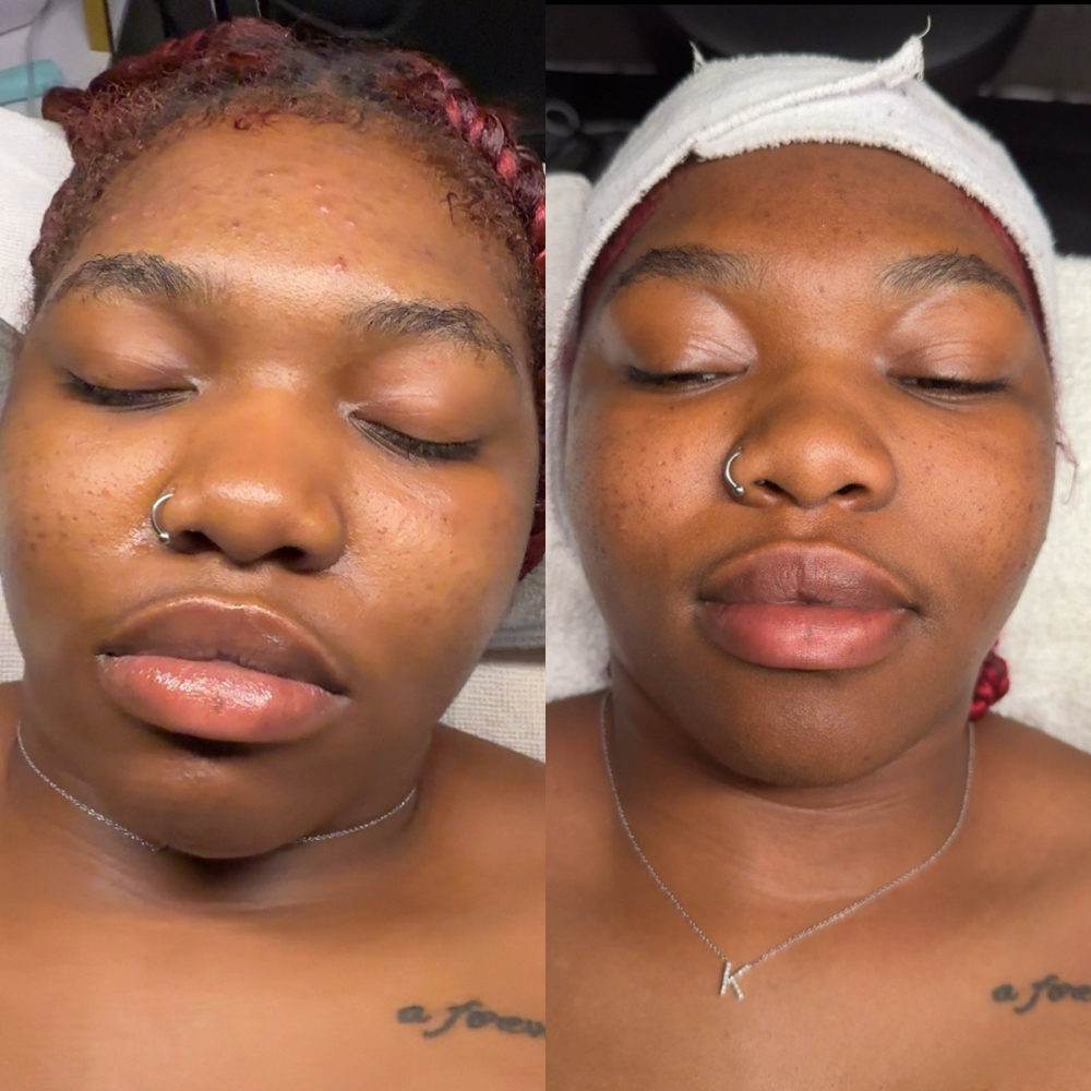 Acne Facial - July Special