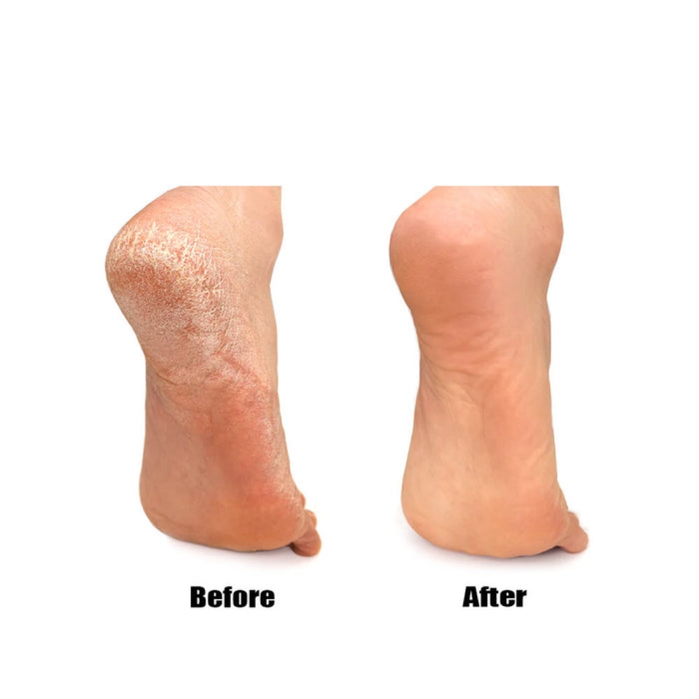 Callus Softening Treatment at Yuly Beauty Salon in Union City, NJ