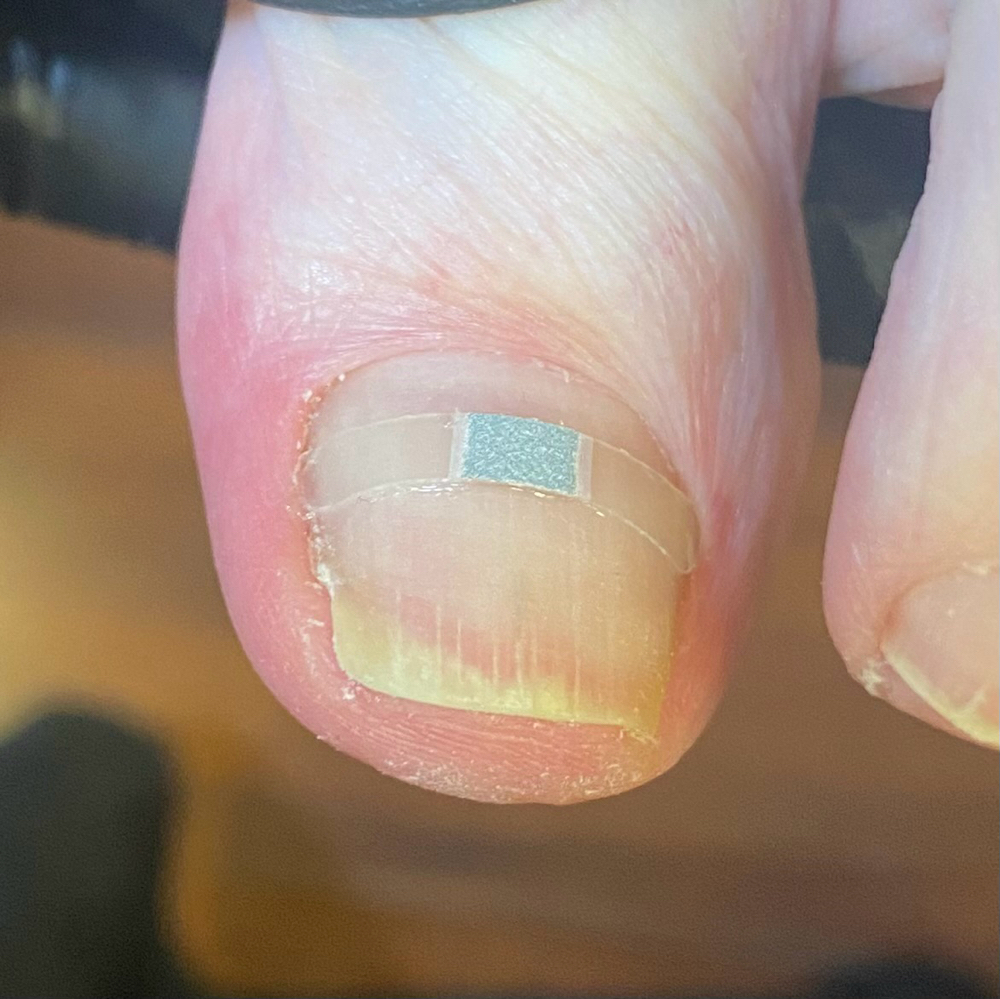 B/S Brace
