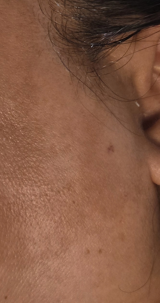 Sideburn Removal