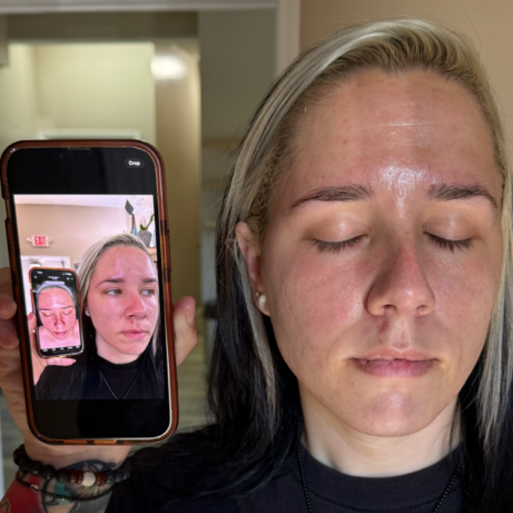 Acne Boot Camp at The Skin Suite 828 in Waynesville, NC