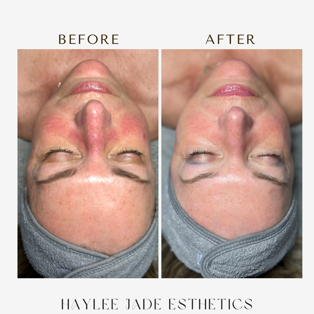 Ultra-Calming Facial