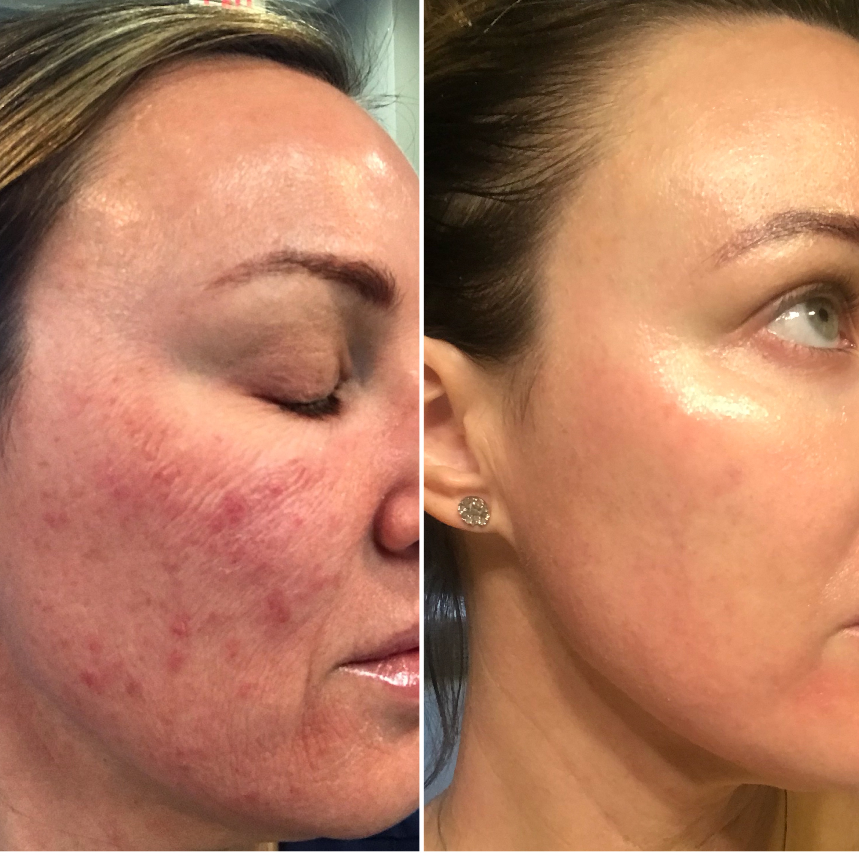 Halo Glow at Trale Beauty in Lewisville, TX