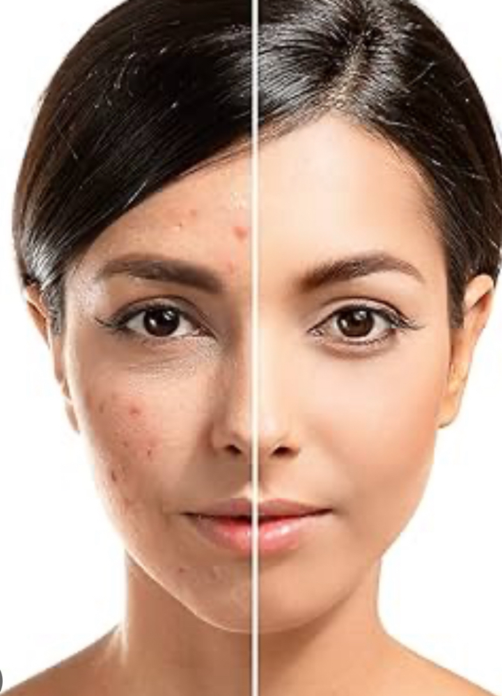 Acne Treatment / Fast Acting
