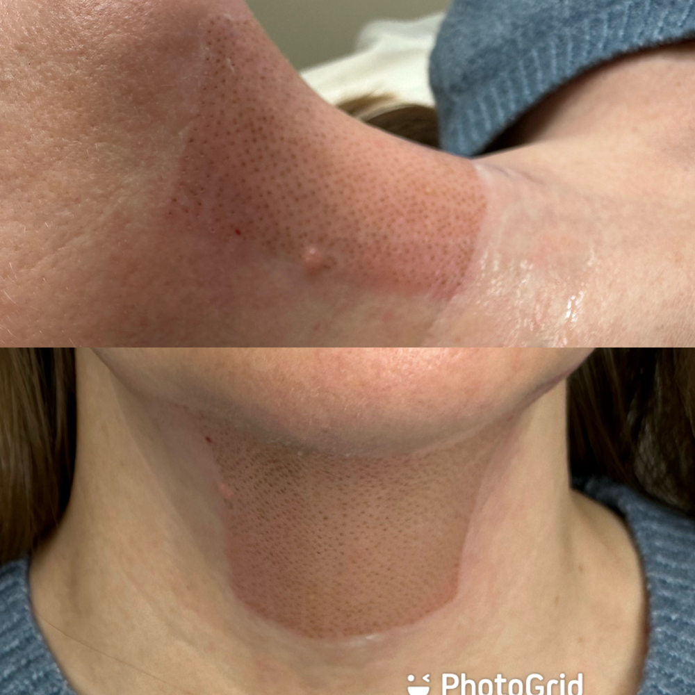 Submental Area Of The Neck