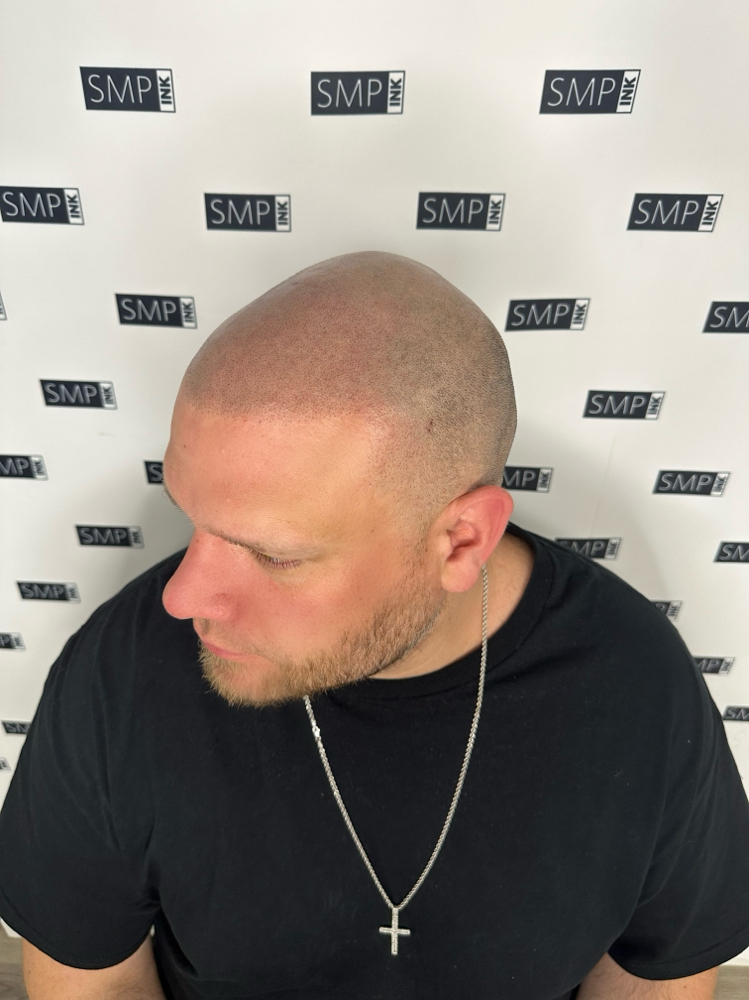 Scalp Micropigmentation