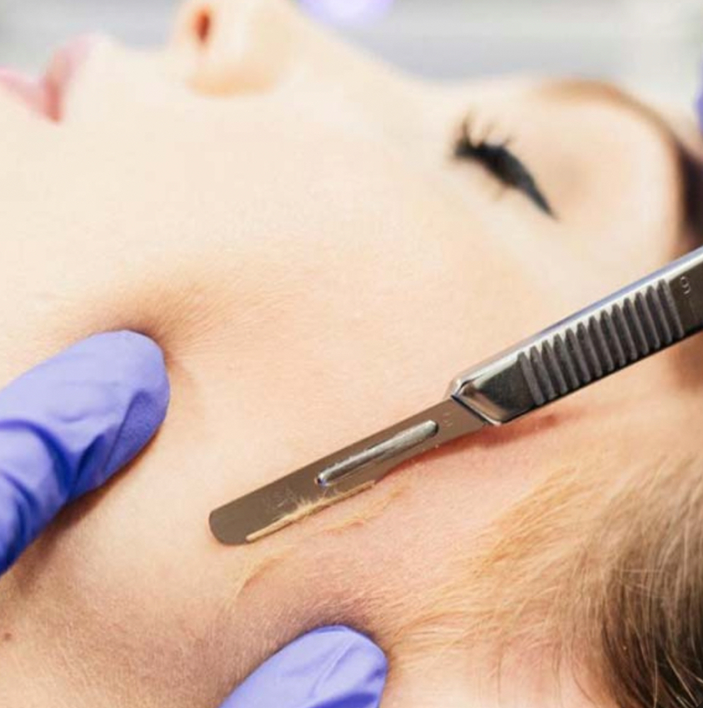 Signature Facial with Dermaplane at SKINDESIGN BY SAM D. in Massapequa, NY
