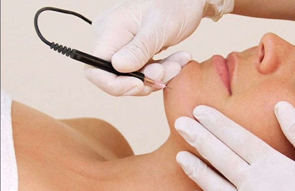 120 Minutes Electrolysis Session
