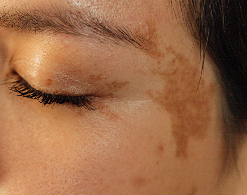 Hyperpigmentation Facial