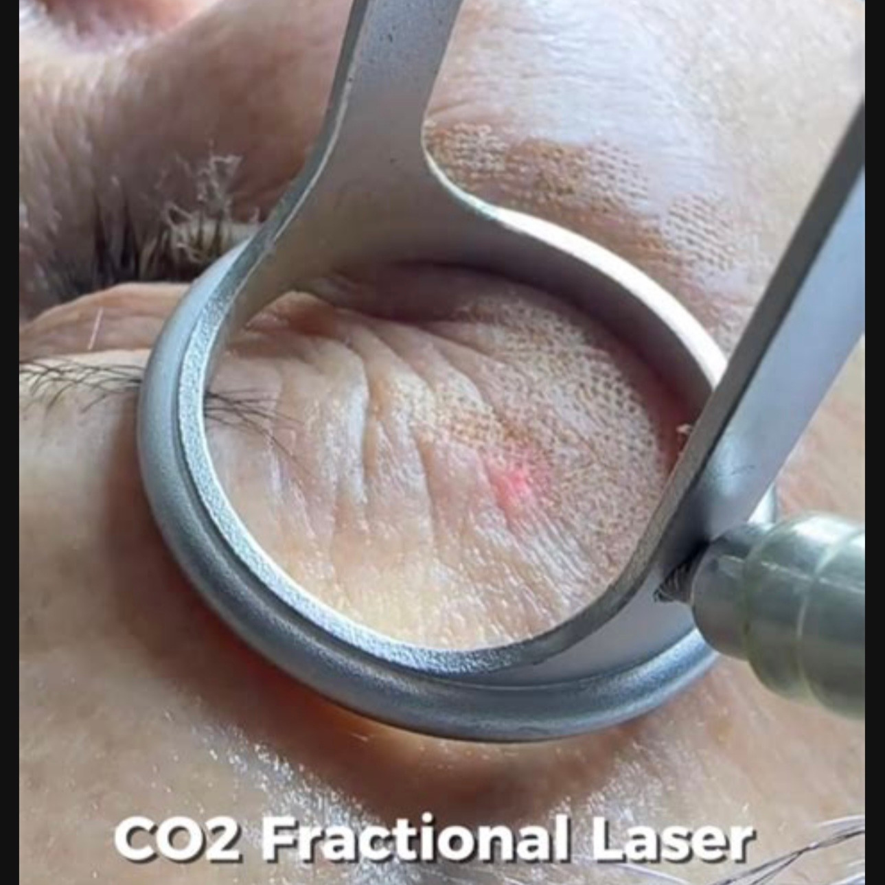 Add-On: CO₂ Eye (Upper/ Lower)