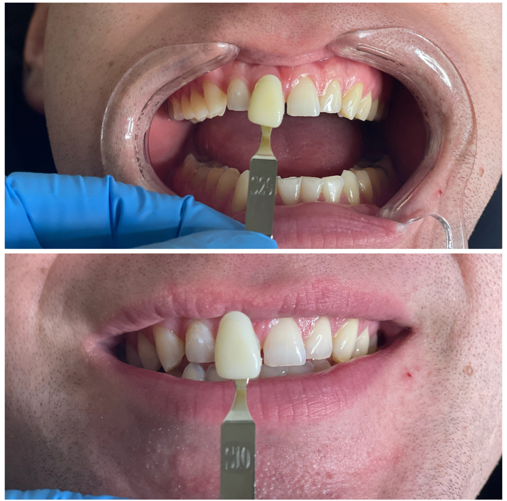 Teeth Whitening