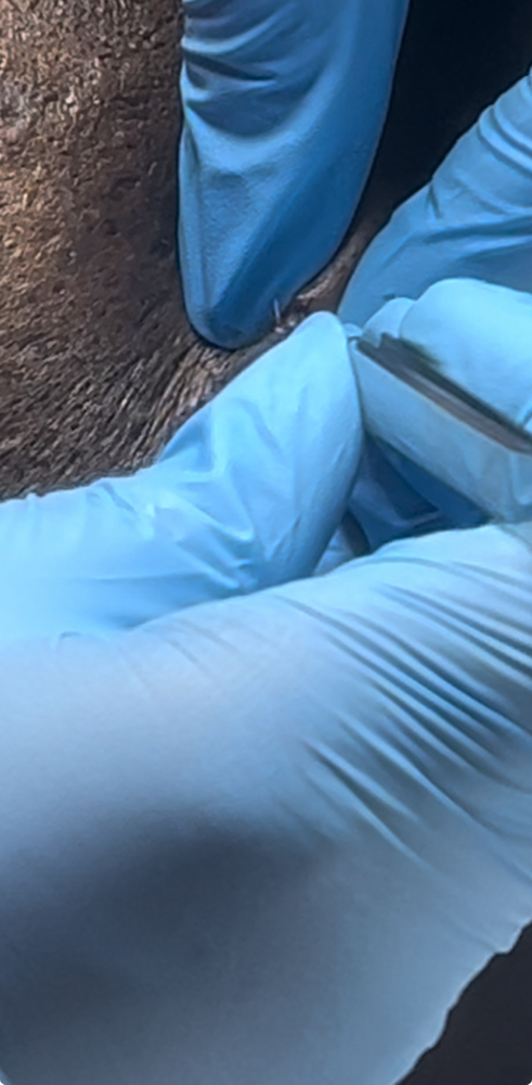 Ingrown/Blackhead  Extraction