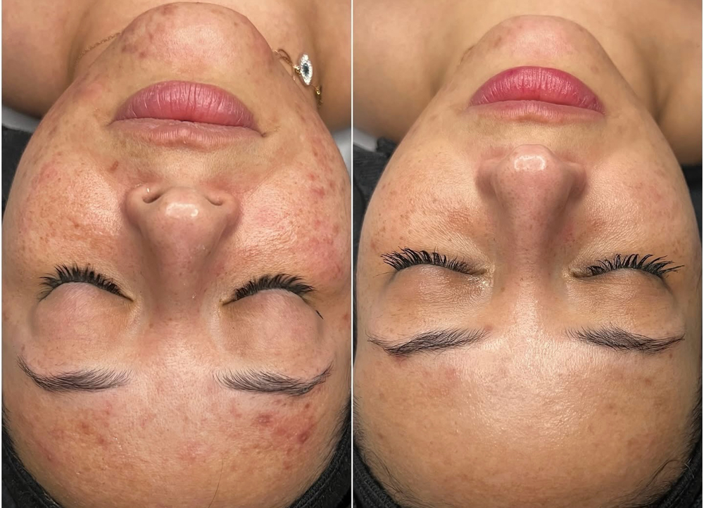 Oxygen Infusion Facial