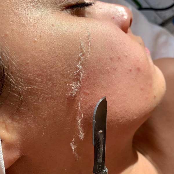 Dermaplane Facial