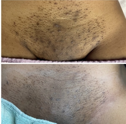 VAJACIAL-II Resurfacing/Lightening at Euphoric Skin and Beauty in Hampton, GA