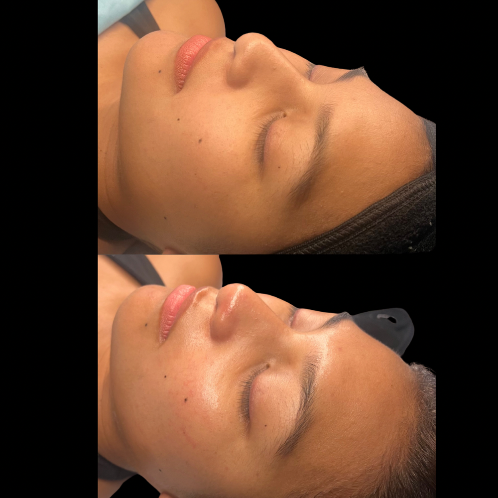 Signature Detox Facial + Microderm