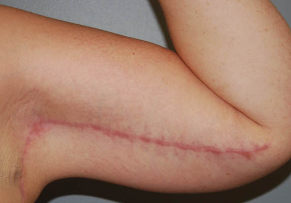 Arm Lift Scar Reduction