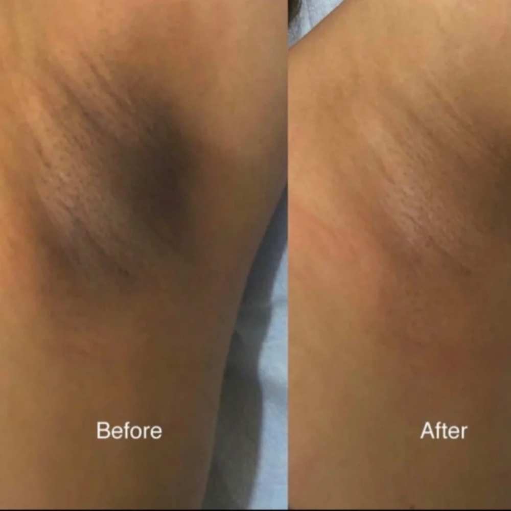 NEWIntimate Bleaching-3 Treatments+ at Advanced Aesthetics by Ang in Layton, UT