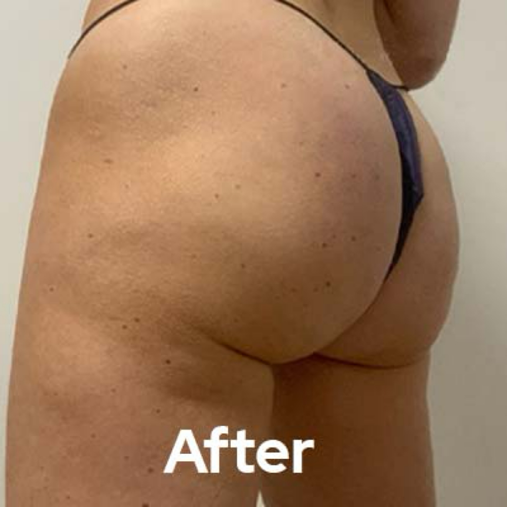EMSZero Muscle Growth Plus RF at Nurse Ink/Rao Med Spa in Covington, LA