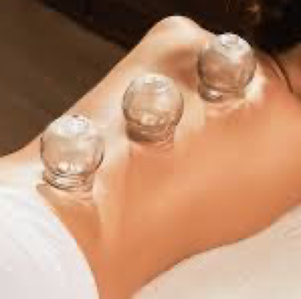 Cupping at Soule’ Healing & Wellness in Tinley Park, IL