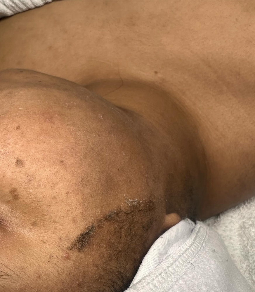 Dermaplane With Brighting Treatment