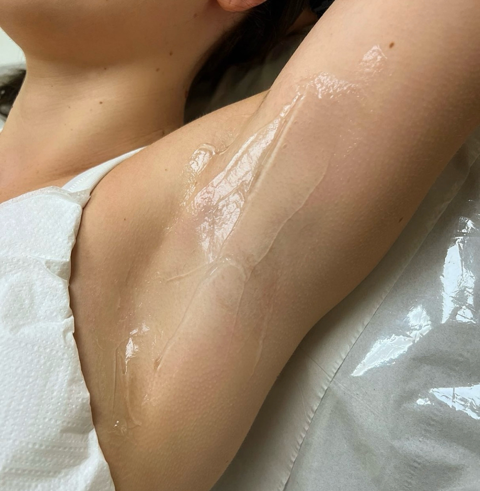 LASER HAIR REMOVAL