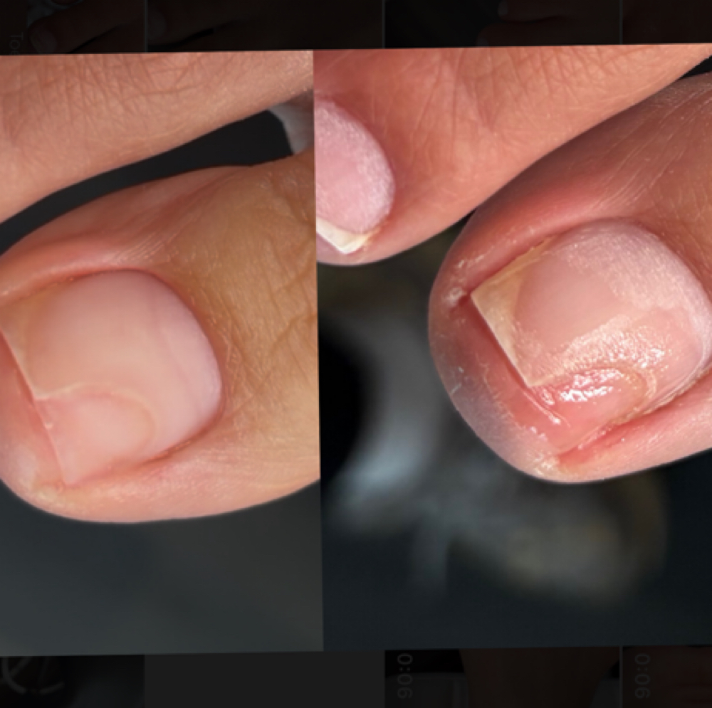 New Toenail Reconstruction at OpulenceTierBeauty in Vancouver, WA