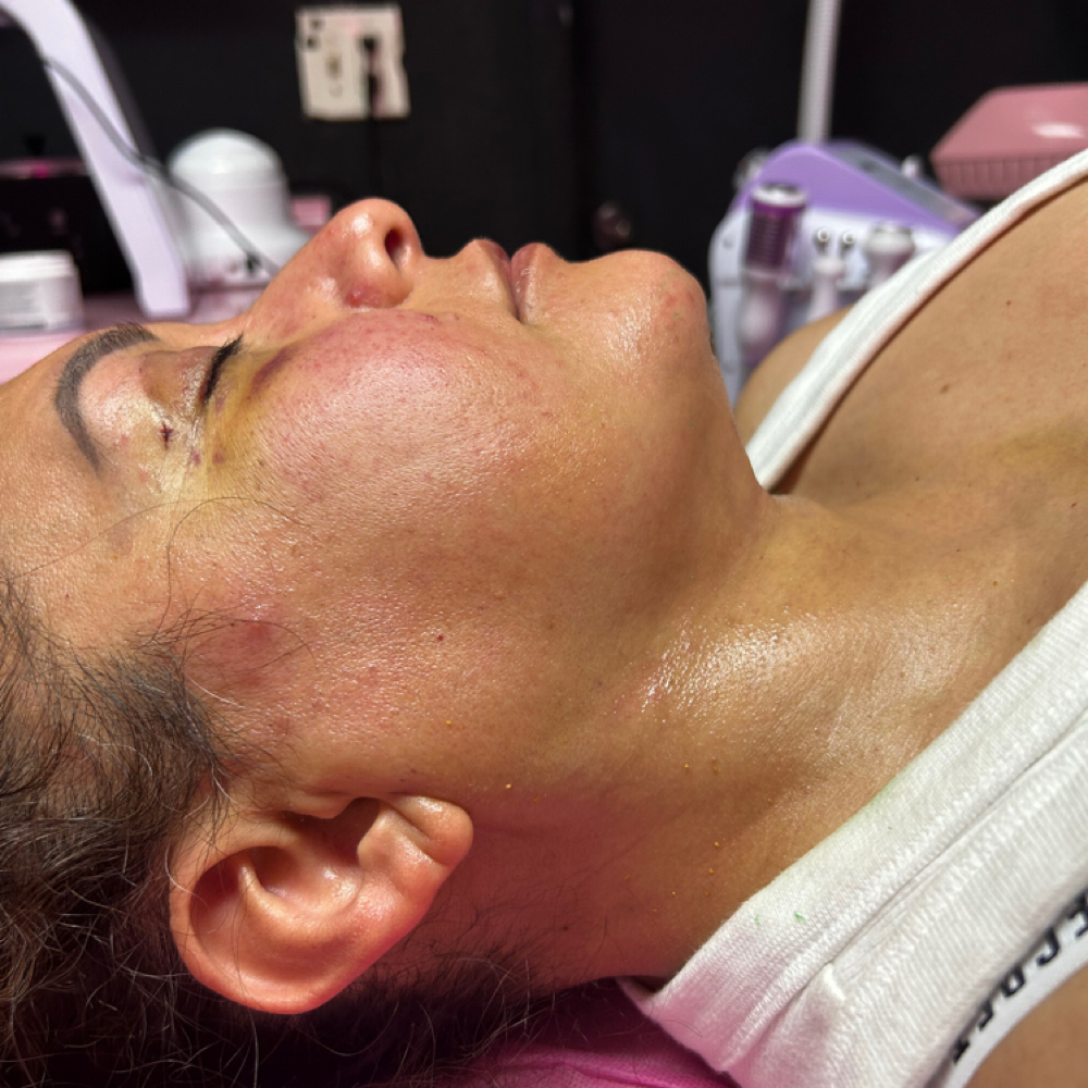 ✨Post Op Glow Touch✨(ChinLipo/FaceL at Nena’s Beauty Glow Bar in North Las Vegas, NV