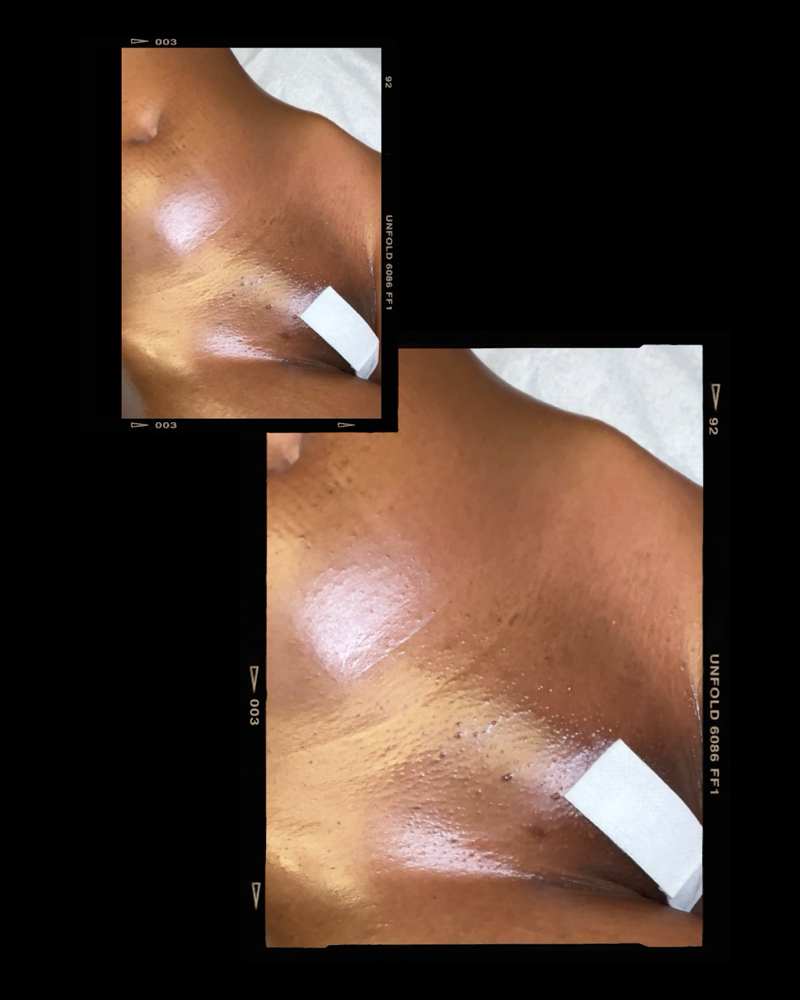 Stomach Strip