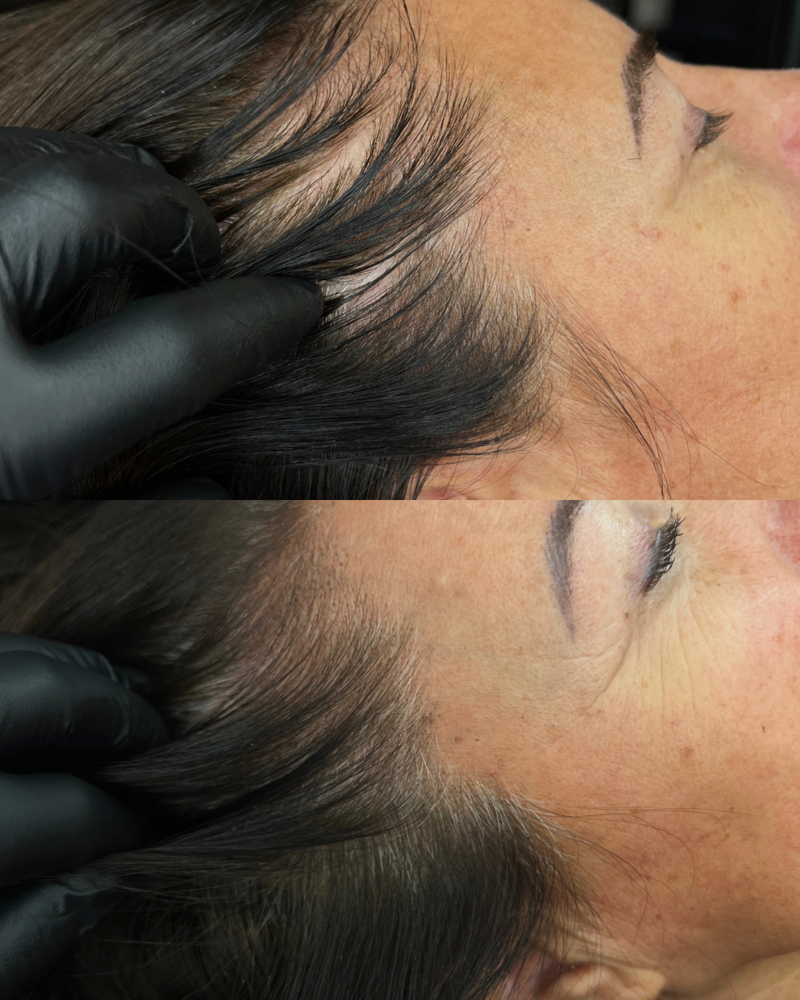 Scalp Micropigmentation